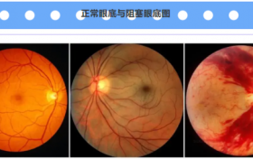 三高人群更容易得眼底病？眼科专家：确实如此